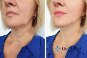 Double chin before and after Hi-Fu treatment 4 Book your double chin treatment Chesham today! We are here to help!