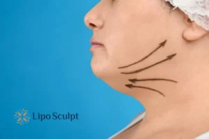 Double chin before and after Hi-Fu treatment 3 Boost your confidence with a Double chin treatment Chesham