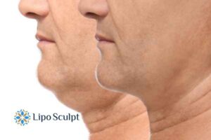 Double chin before and after Hi-Fu treatment 2 Double chin treatment Chesham from Lipo Sculpt - feel more confident today!