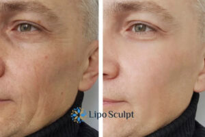 How to Fight Aging Symptoms 3 Fight Aging Symptoms Chesham With HIFU and Morpheus8 Today!