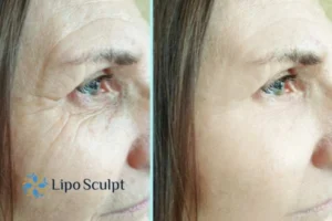 How to Fight Aging Symptoms 2 Do you want to Fight Aging Symptoms Chesham? Contact Lipo Sculpt today!