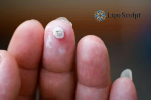 Cryopen Top 5 Treatable Conditions 4 Do you have a persistent wart of verruca that you cannot shit? Cryopen Chesham treatment will work call us NOW!