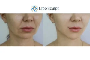Explaining Total Skin Tightening Treatment And What It Can Do For You 2 Do you want to boost your self confidence? Give Morpheus8 Chesham a try today!