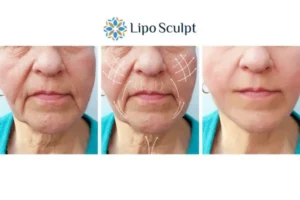 Explaining Total Skin Tightening Treatment And What It Can Do For You 3 Boost your confidence with Morpheus8 Chesham call our team today!