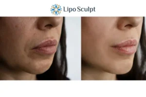 Explaining Total Skin Tightening Treatment And What It Can Do For You 4 Morpheus8 Chesham the best results - call our team today!