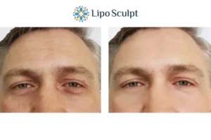 Explaining Total Skin Tightening Treatment And What It Can Do For You 6 Morpheus8 Chesham book in today to find out more!
