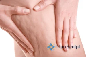 CoolSculpting for Legs: The Innovative Approach to Redefining Your Legs 5 Start your journey today book your coolsculpting treatment Chesham online today!