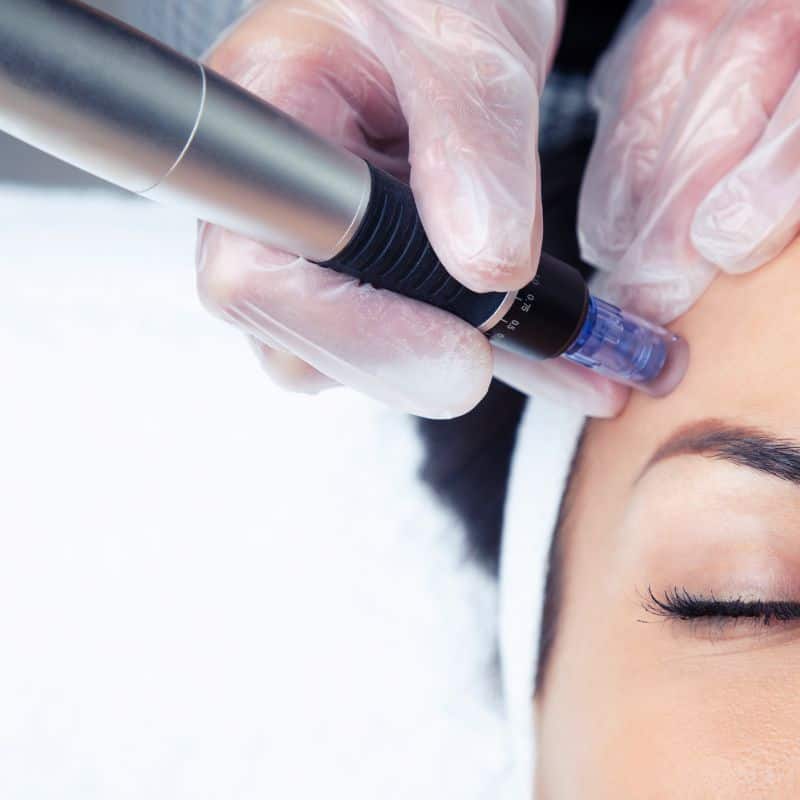 Morpheus8 treatment Chesham from Lipo Sculpt - Book in today!