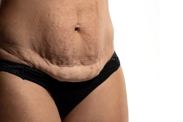 Lost the Weight but Not the Loose Skin? 1 image of womans stomach after weight loss showing loose skin Chesham